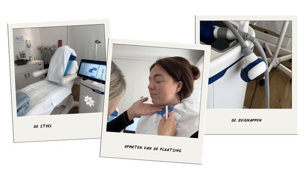 onderkin wegvriezen coolsculpting