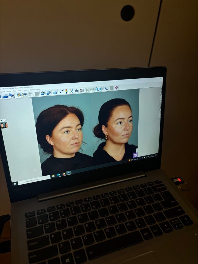 onderkin wegvriezen coolsculpting