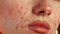 rosacea huid behandeling food triggers