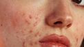 rosacea huid behandeling food triggers