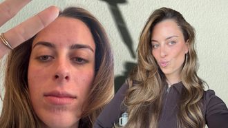 microneedling ervaring