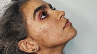skin-positivity acne
