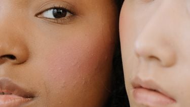 acne feiten fabels